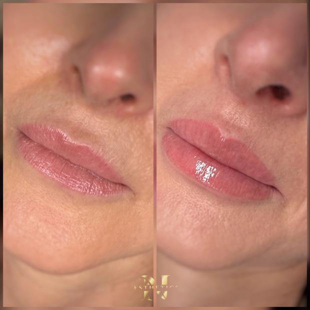 Szkolenie z Wypełniania i Modelowania ust