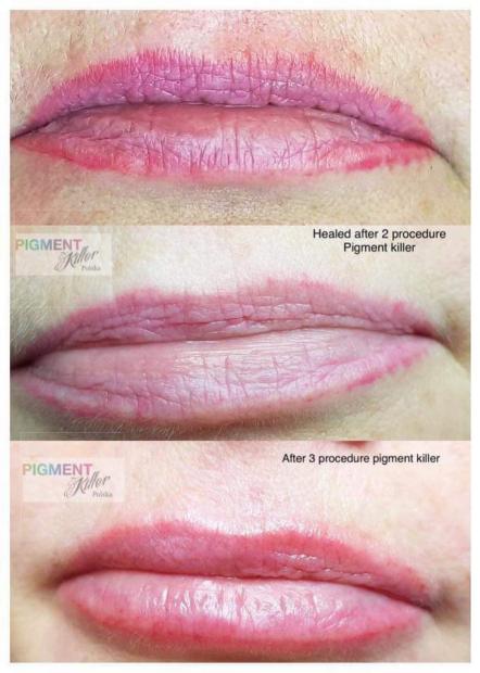 Bezlaserowe usuwanie nieudanego makijażu permanentnego