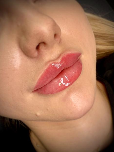 Szkolenie z Wypełniania i Modelowania ust