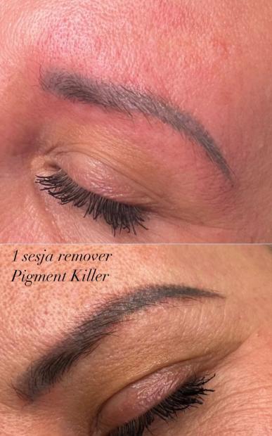 Bezlaserowe usuwanie nieudanego makijażu permanentnego