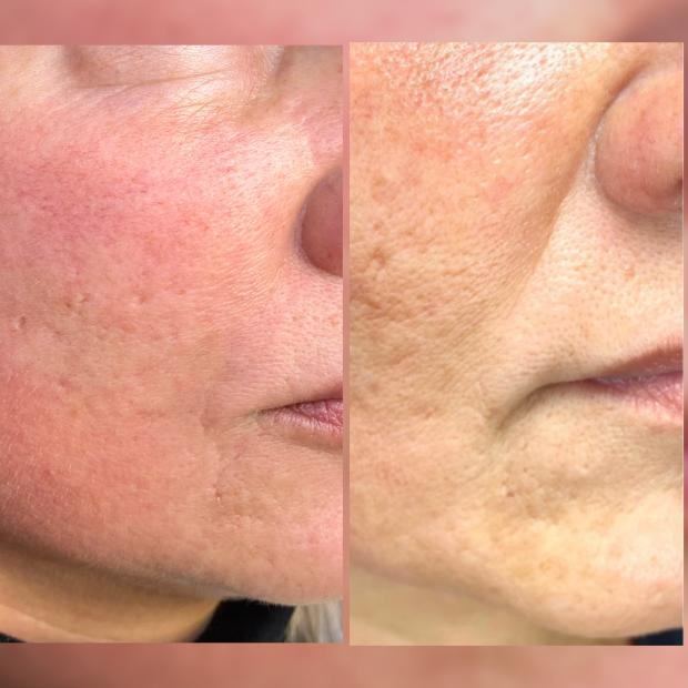 Mezoterapia igłowa Stymulatory Tkankowe