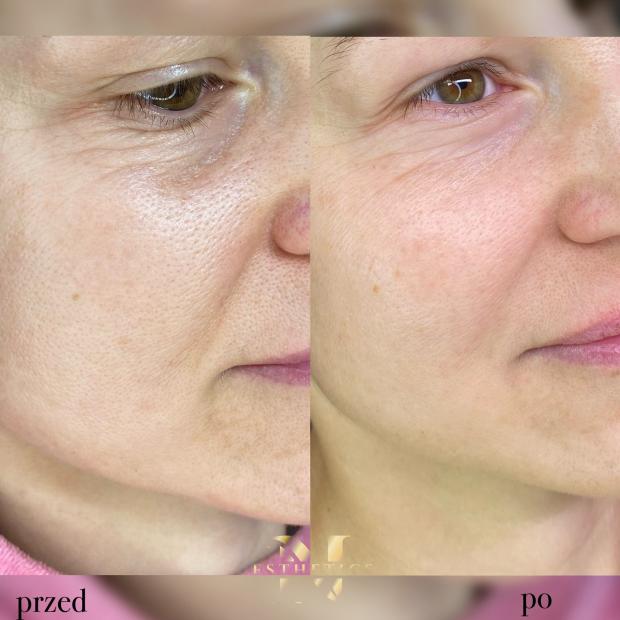 Mezoterapia igłowa Stymulatory Tkankowe