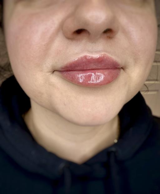 Szkolenie z Wypełniania i Modelowania ust