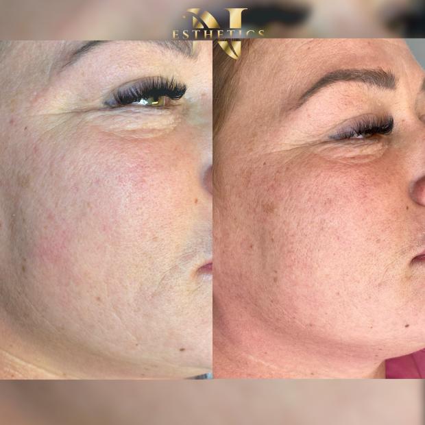 Mezoterapia igłowa Stymulatory Tkankowe